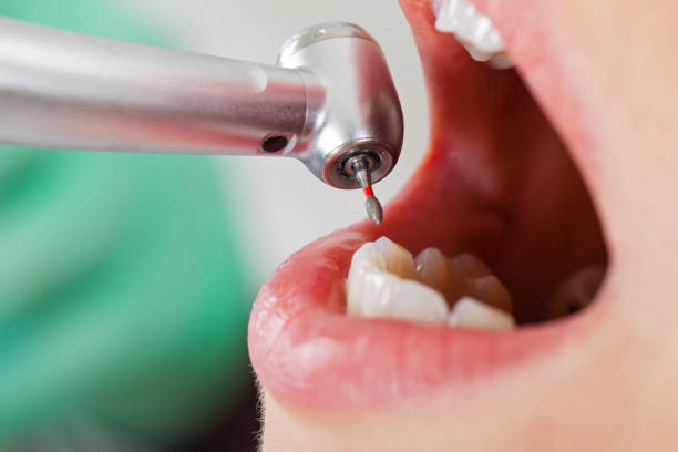 Best Chipped Tooth Repair Near Me  in La Crescenta Montrose, CA